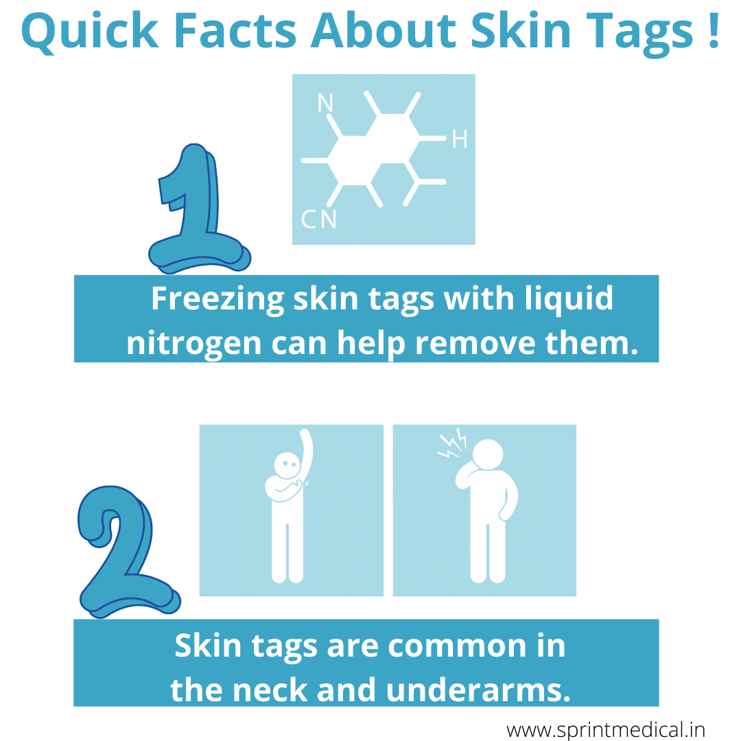 Quick facts about skin tag