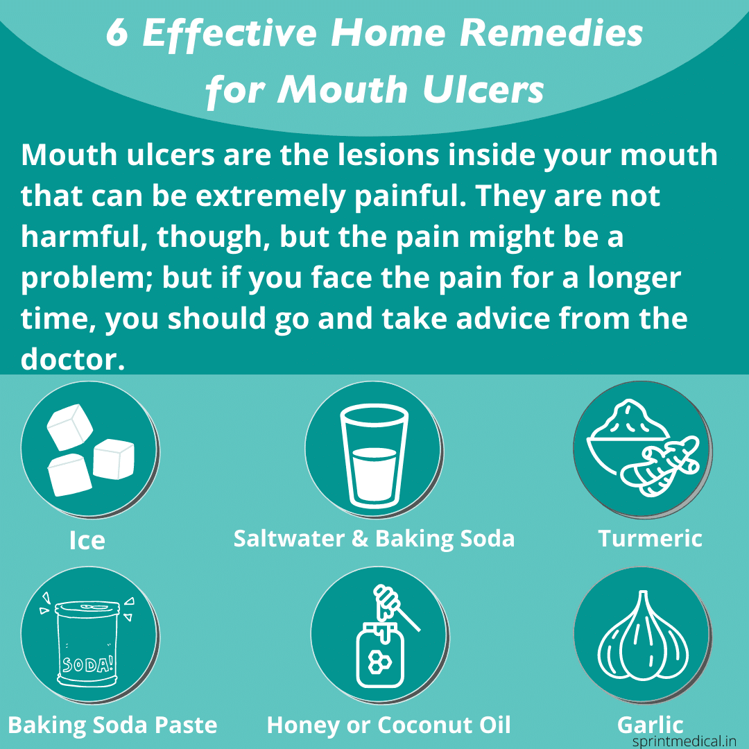 6 Effective Home Remedies for Mouth Ulcers