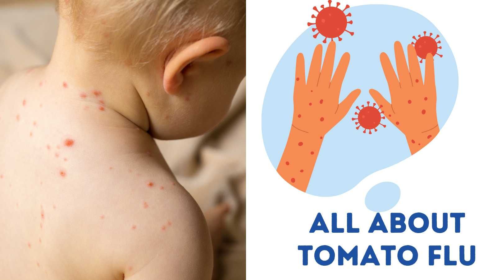 All-about-Tomato-flu.jpg