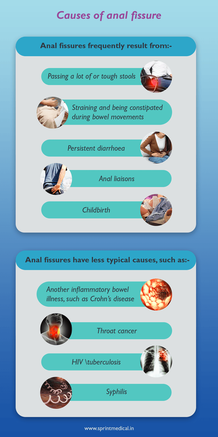 Causes of anal fissure