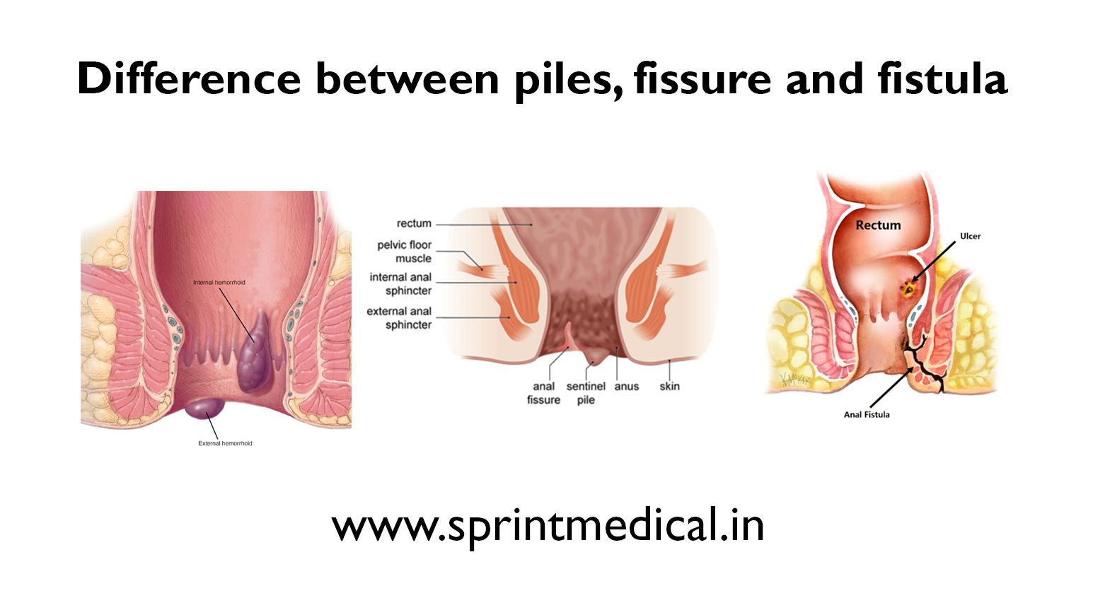 Difference between piles and fissure and fistula