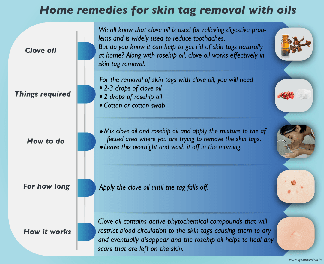 Home-remedies-for-skin-tag-removal-clove-oil
