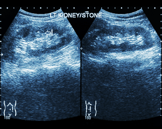 Kidney Stone Ultrasound