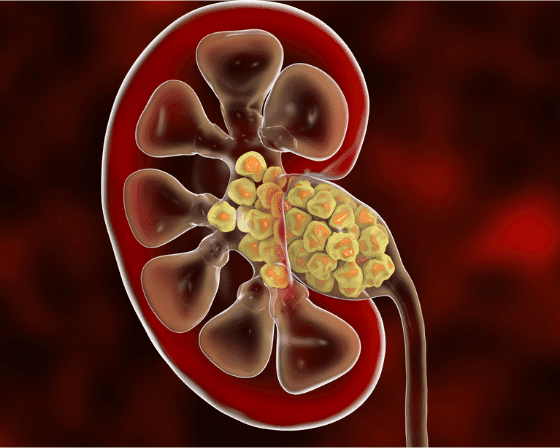 Kidney Stones Infographic