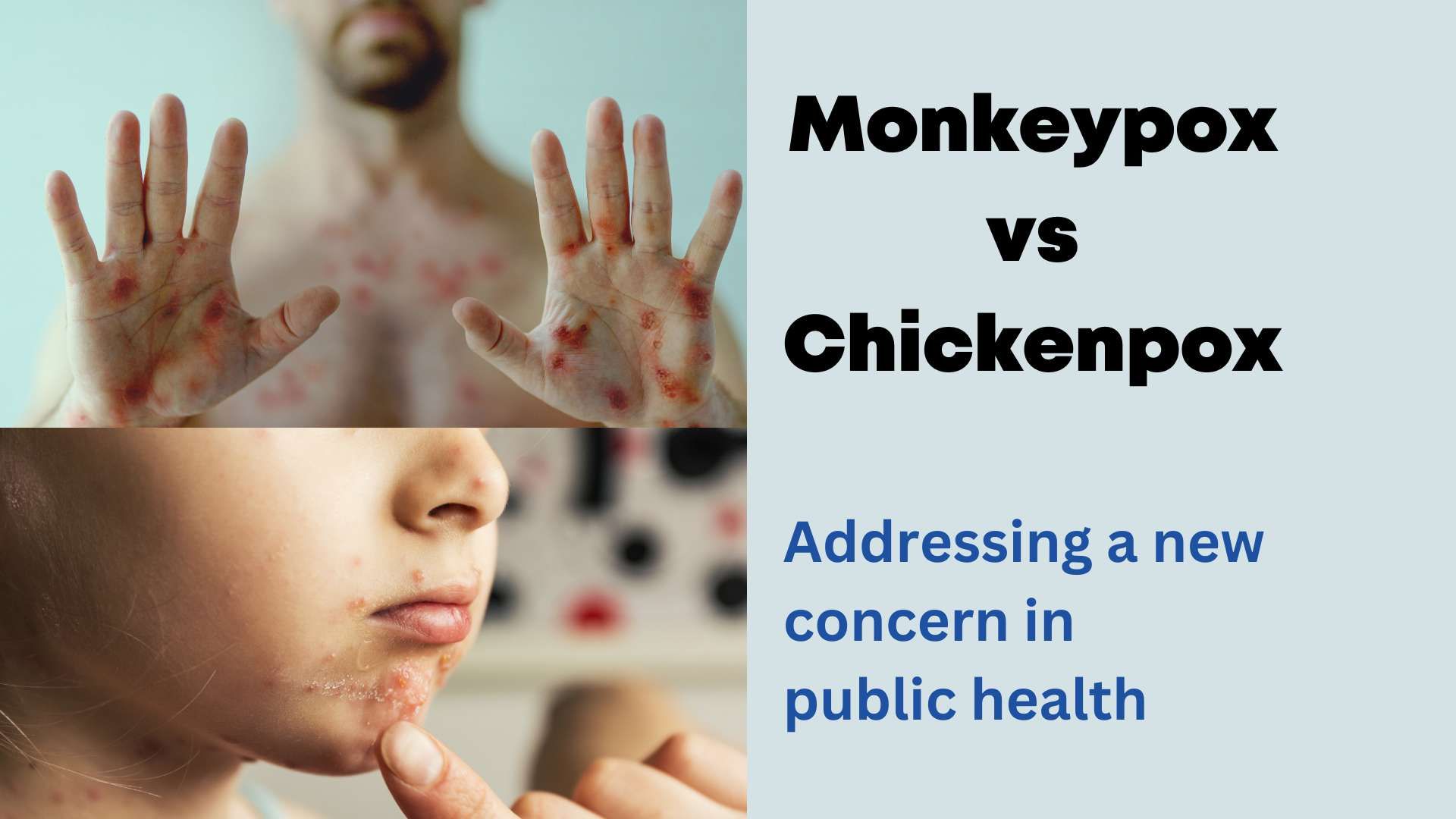 Monkeypox-vs-Chickenpox-Addressing-a-new-concern-in-public-health.jpg