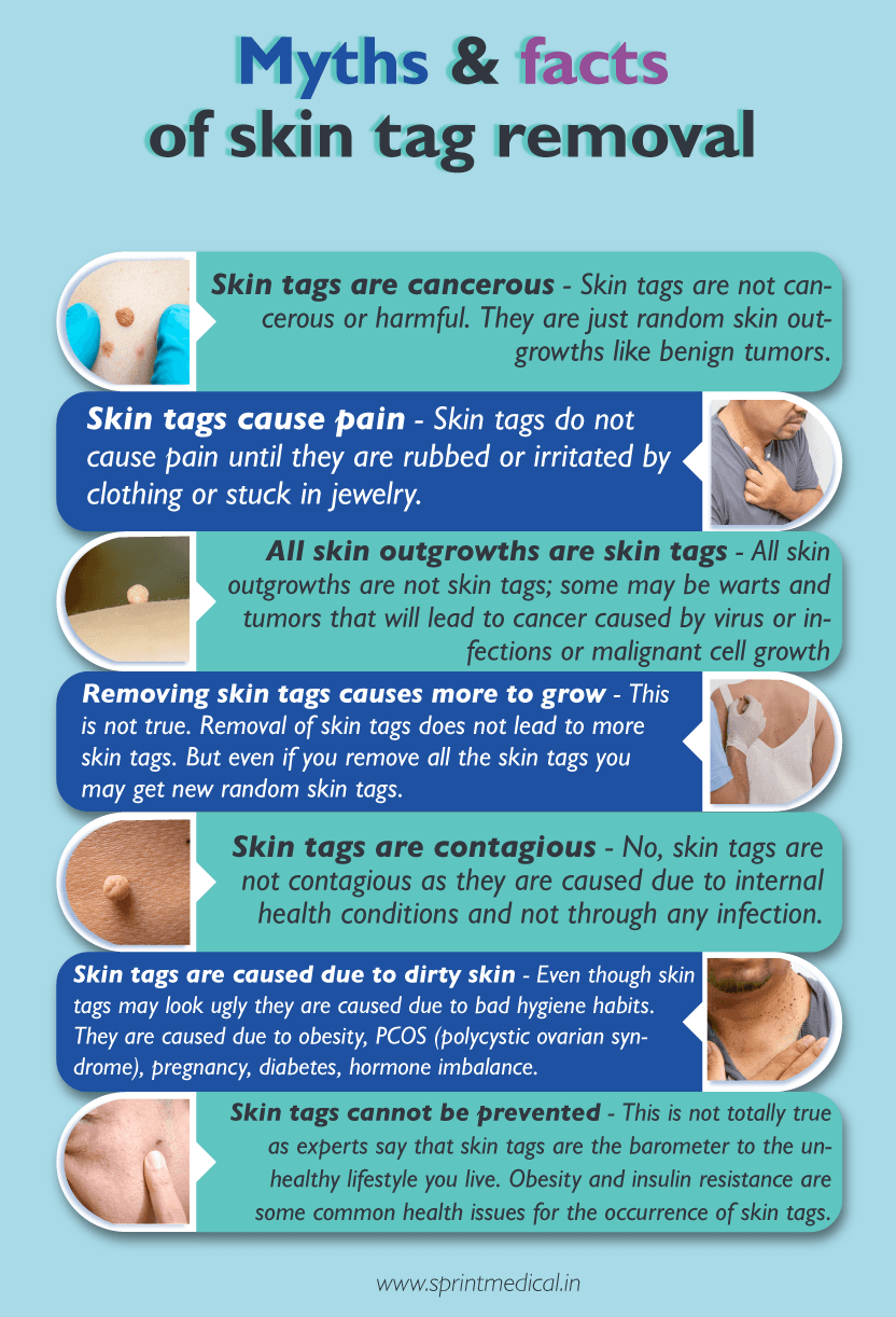 Myths-and-facts-of-skin-tag-removal