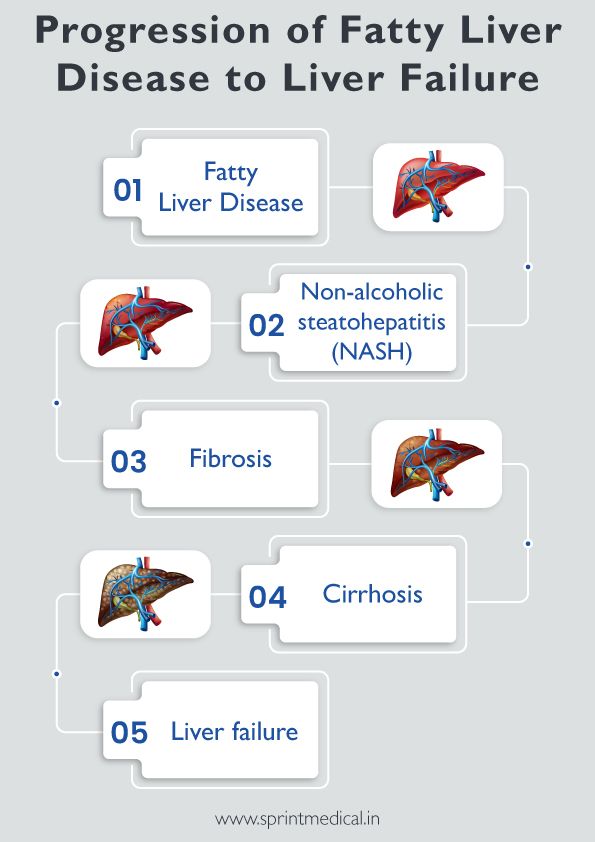 Progression of Fatty Liver Disease to Liver Failure