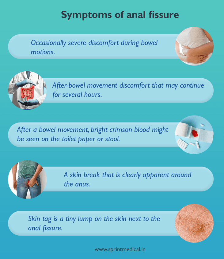 Symptoms of anal fissure