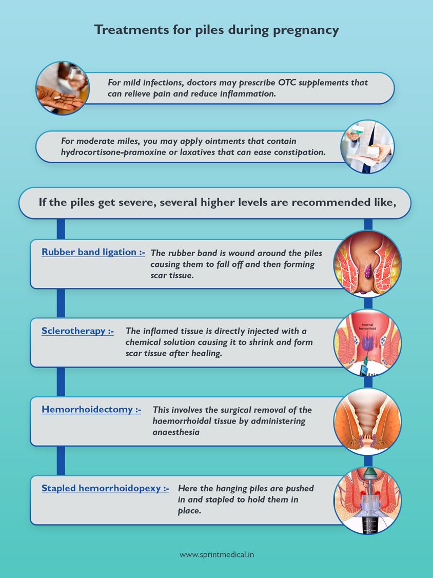 Treatments for piles during pregnancy