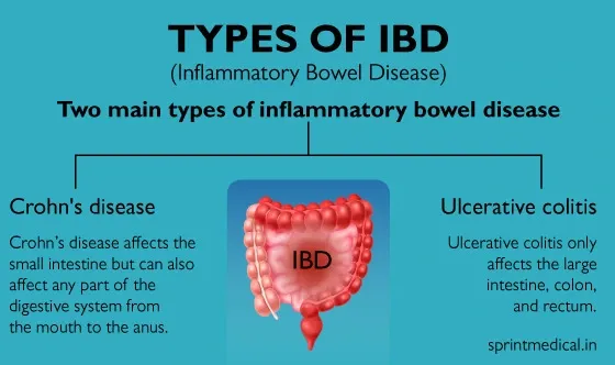 Types of IBD (Inflammatory Bowel Disease)