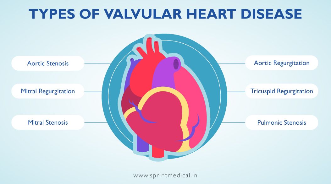Types of Valvular Heart Disease