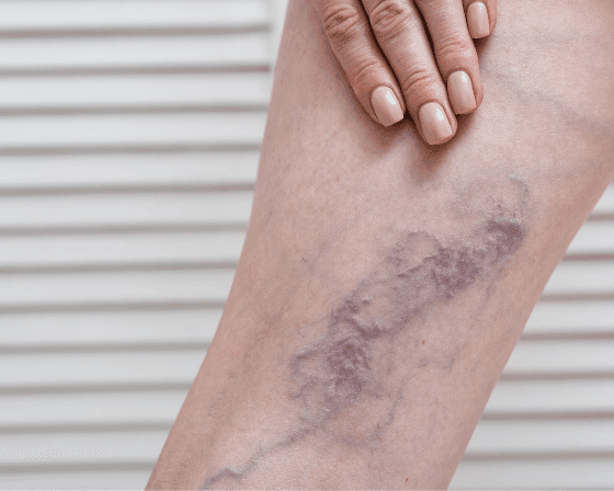 Thrombosis in Deep Vein or Blood Clotting 