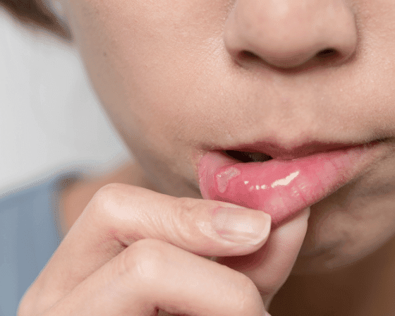 Mouth Ulcers: Their Symptoms, Causes, and Treatment