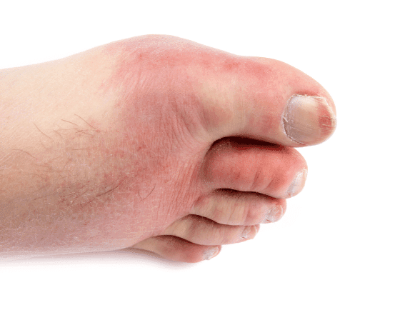 Is that pain in my toe, Gout?