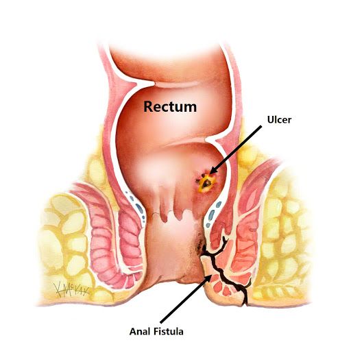 What are anal fistula