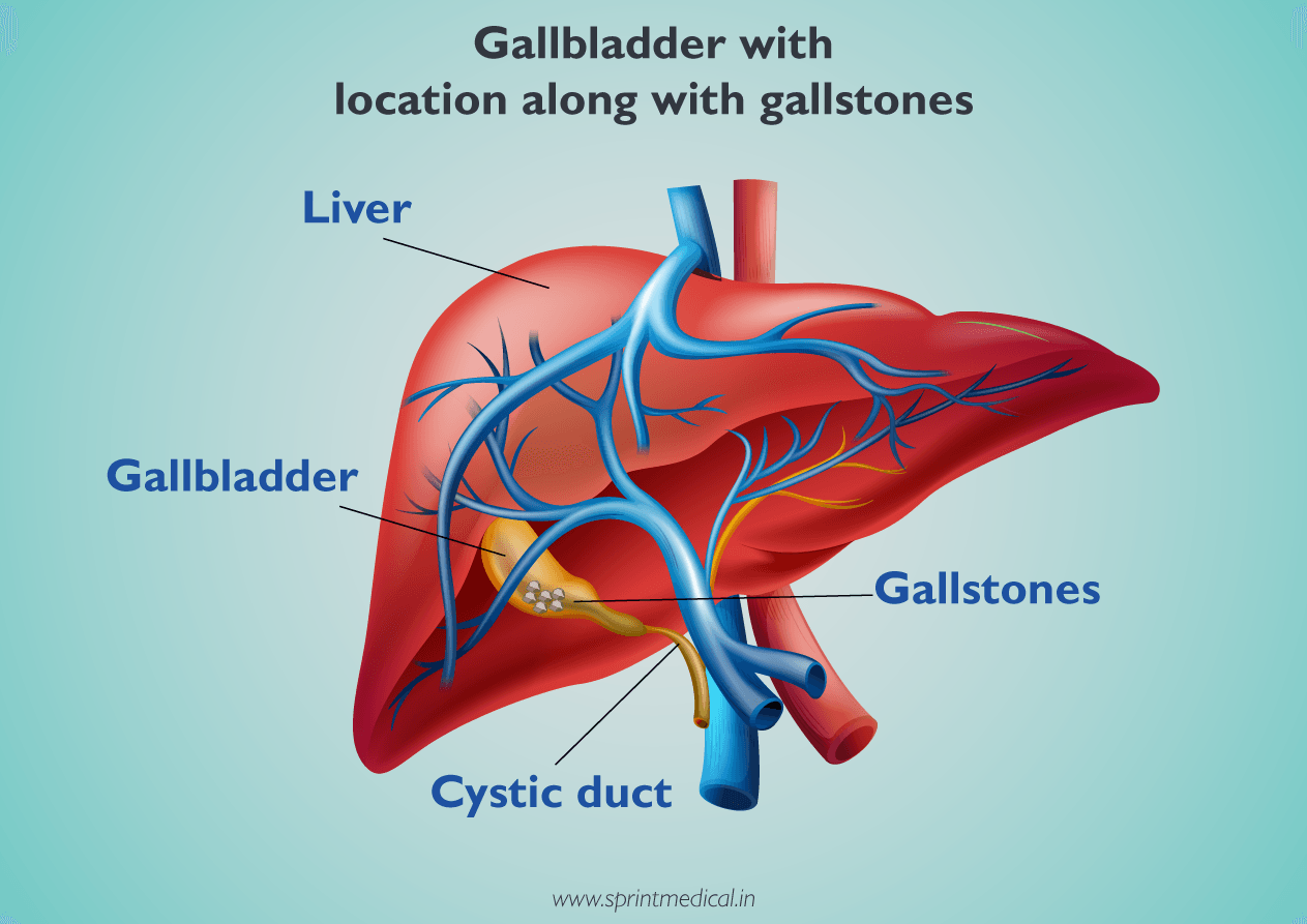 What are gallstones or gallbladder pathri
