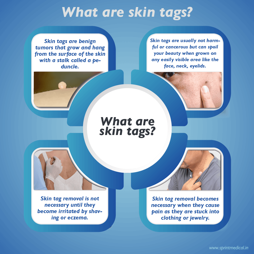 What are skin tags? 