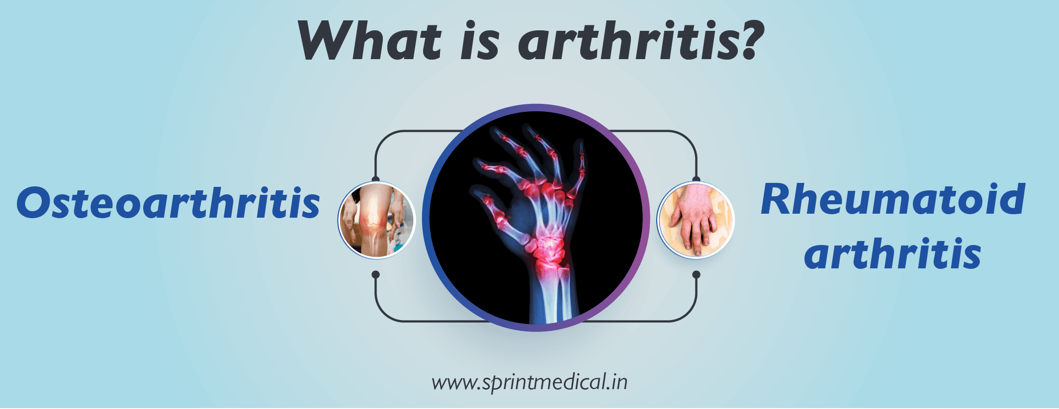What is arthritis