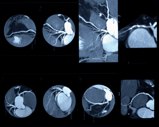 difference between Angiography and Angioplasty 2