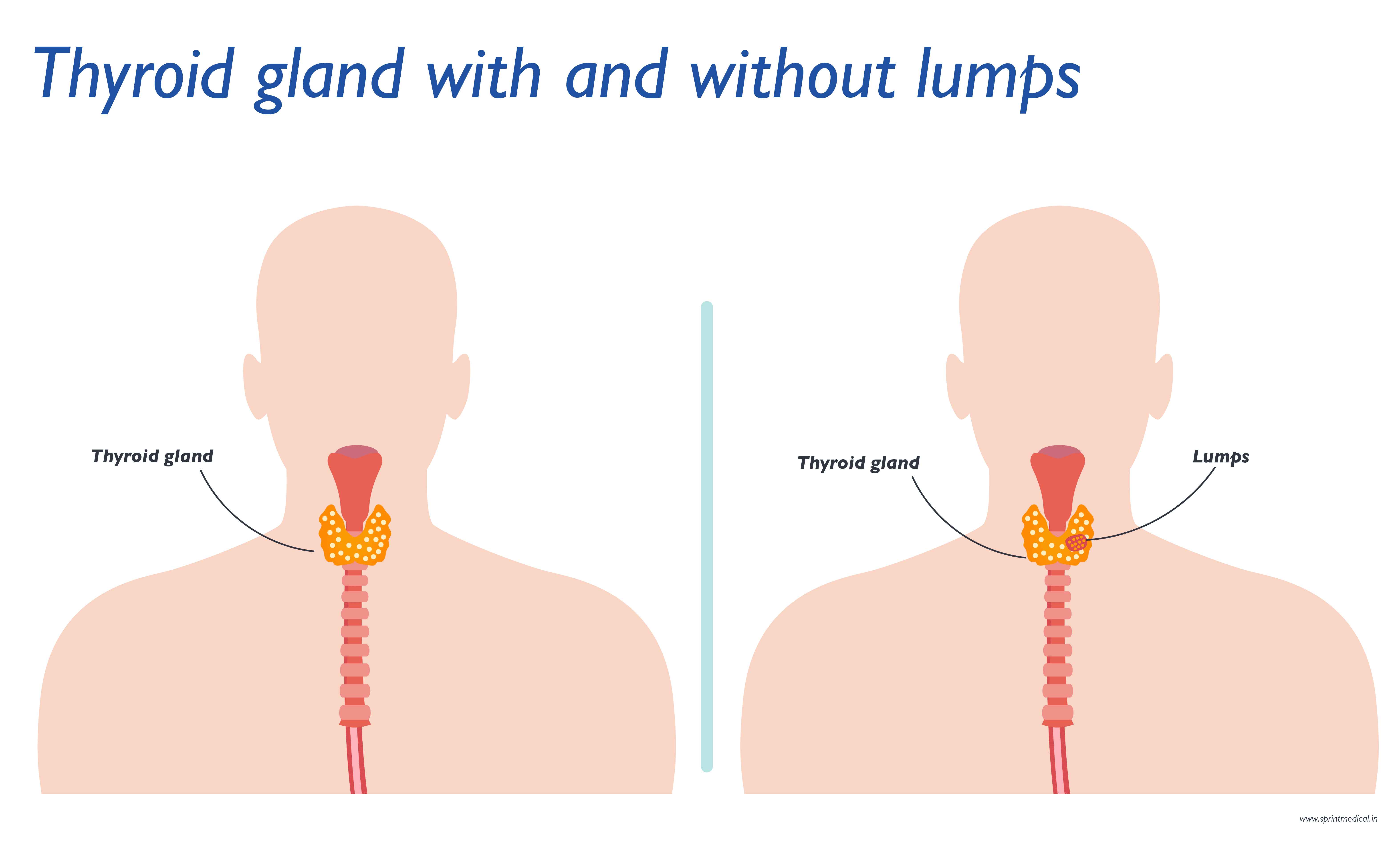 infographic of the with and without lumps