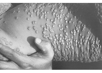 smallpox lesions